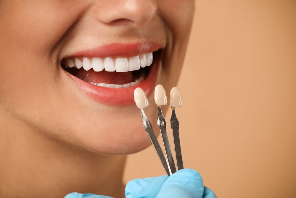 Veneers