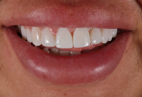 After -Smile Success